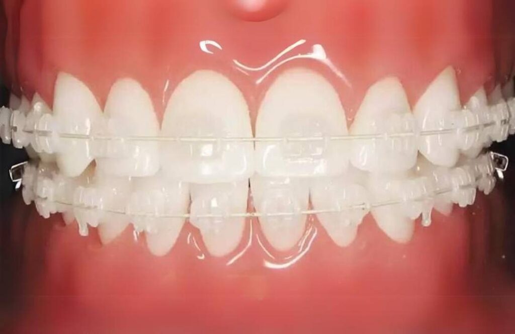 3m clarity advance dr ozlem aylikci ortodonti uzmani seffaf braketler dis yuzeinde braket gorunmesin typodont