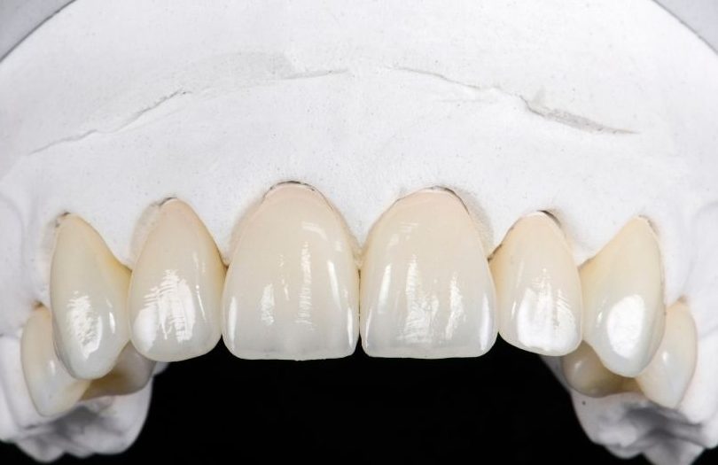 Dr. Ozlem Aylikci Drozlemorto Gulus Tasarim Uzmani dr. Bahadir Ugur Aylikci E Max veneer Emax kaplama model farkli vaka rotated 1