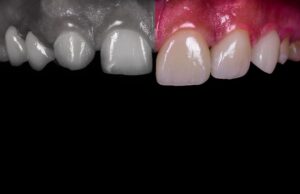 Dr. Ozlem Aylikci Drozlemorto Gulus Tasarim Uzmani dr. Bahadir Ugur Aylikci Zirkonyum Veneer Zirkonyum Kaplama Hasta