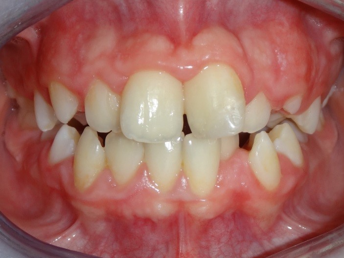 ortodonti uzmanı dr. özlem aylıkcı Çocuk ortodontisi Çocuklarda ortodonti invisalign teen invisalign first çocuklarda şeffaf plak