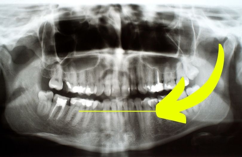 Dr ozlem aylikci ortodonti uzmani seffaf plak uzmani invisalign uzmani alveoler kemik seviyesi