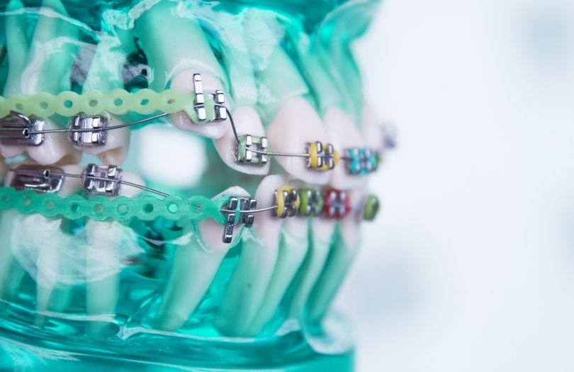 Dr ozlem aylikci ortodonti uzmani seffaf plak uzmani invisalign uzmani dis teline ucgen lastik takma lastik takma yontemleri elastik model