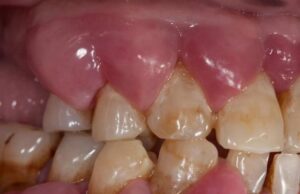 Dr. Ozlem Aylikci Drozlemorto Gulus Tasarim Uzmani dr. Bahadir Ugur Aylikci Dis Eti Buyumesi Gingival Enlargment