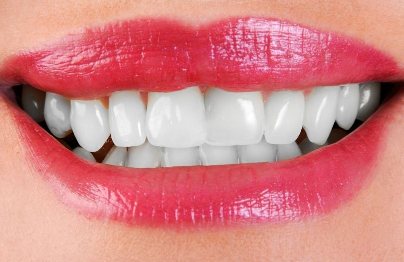 Dr. Ozlem Aylikci Drozlemorto Gulus Tasarim Uzmani dr. Bahadir Ugur Aylikci Dis beyazlatma Bleaching aftery 1