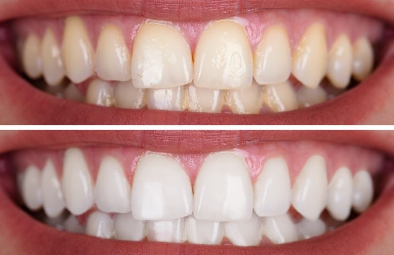 Dr. Ozlem Aylikci Drozlemorto Gulus Tasarim Uzmani dr. Bahadir Ugur Aylikci Dis beyazlatma Bleaching before after 2 1