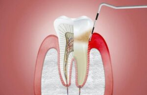 Dr. Ozlem Aylikci Drozlemorto Gulus Tasarim Uzmani dr. Bahadir Ugur Aylikci Gingivitis Probing 1