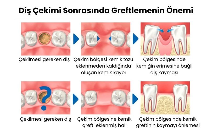 Dr. Ozlem Aylikci Drozlemorto Gulus Tasarim Uzmani dr. Bahadir Ugur Aylikci alveolar kemik grefti cekim boslupunu greftlemenin onemi
