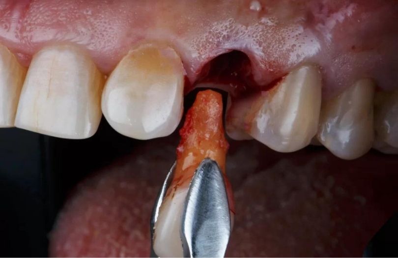 dis cekimi Dr Bahadir Ugur Aylikci lamine Uzmani Implant Uzmani Dis eti Uzmani Periodontoloji Uzmani Gulus Tasarimi Uzmani 1