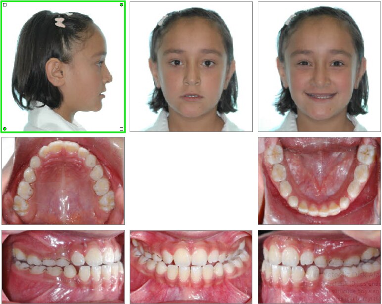 Ortodonti Uzmani Dr. Ozlem Aylikci 10 before